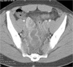 Pid With Tubo-ovarian Abscesses - CTisus CT Scan