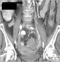 Dilated Left Ovarian Artery - CTisus CT Scan