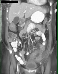 Colitis - CTisus CT Scan