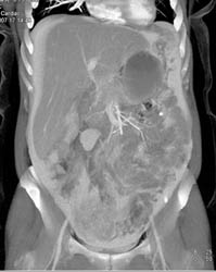 Peritoneal Contrast With Carcinomatosis - CTisus CT Scan