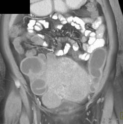 Tubo-ovarian Abscess With Dilated Fallopian Tubes - CTisus CT Scan