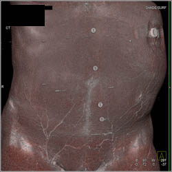 Peritoneal Contrast for Chemotherapy - CTisus CT Scan