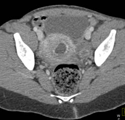 Early in Utero Pregnancy - CTisus CT Scan