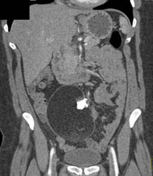 Dermoid- Teratoma - CTisus CT Scan