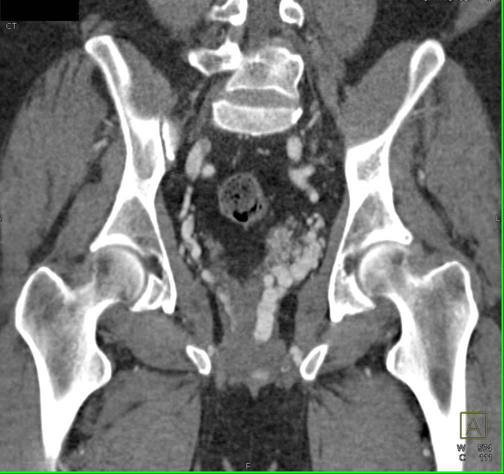 Vascular Malformation in the Pelvis with Detailed CTA Displays - CTisus CT Scan