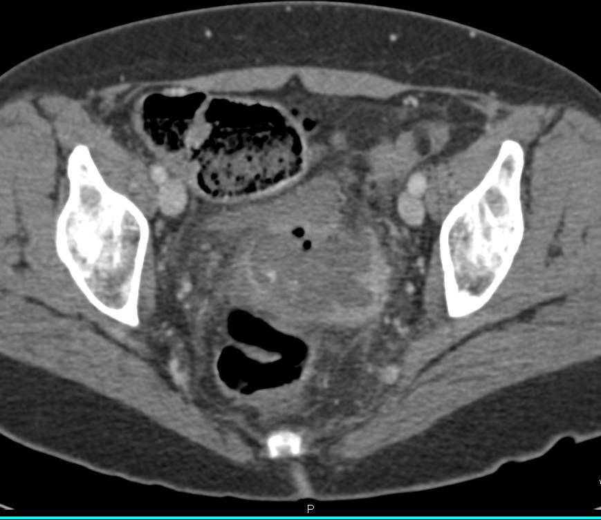 Pelvic Abscess - CTisus CT Scan