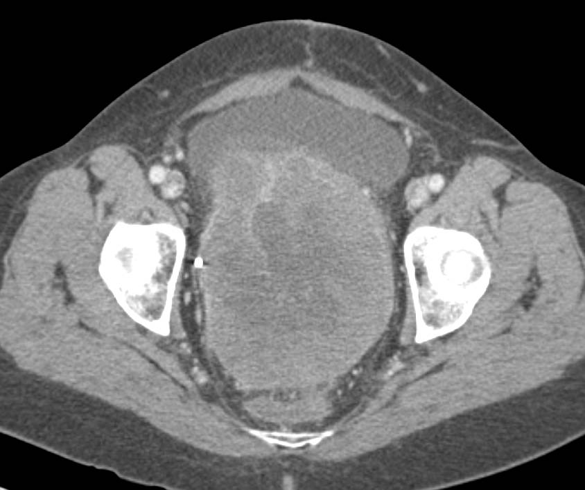 Cystadenocarcinoma of the Ovary with Implants Including on the Spleen - CTisus CT Scan