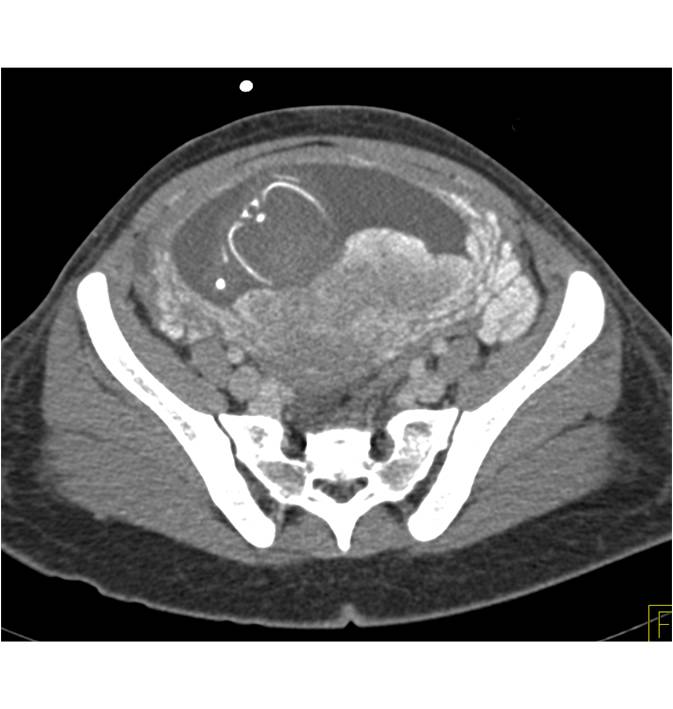 Intrauterine Pregnancy in a Trauma Patient - CTisus CT Scan