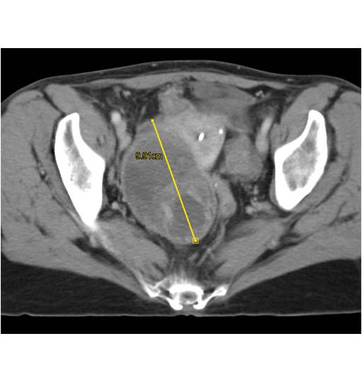 Ovarian Cystadenocarcinoma with Tumor Spread - CTisus CT Scan