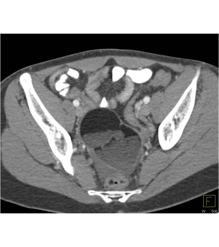 Ovarian Teratoma with Fatty Lesion in the Liver - CTisus CT Scan