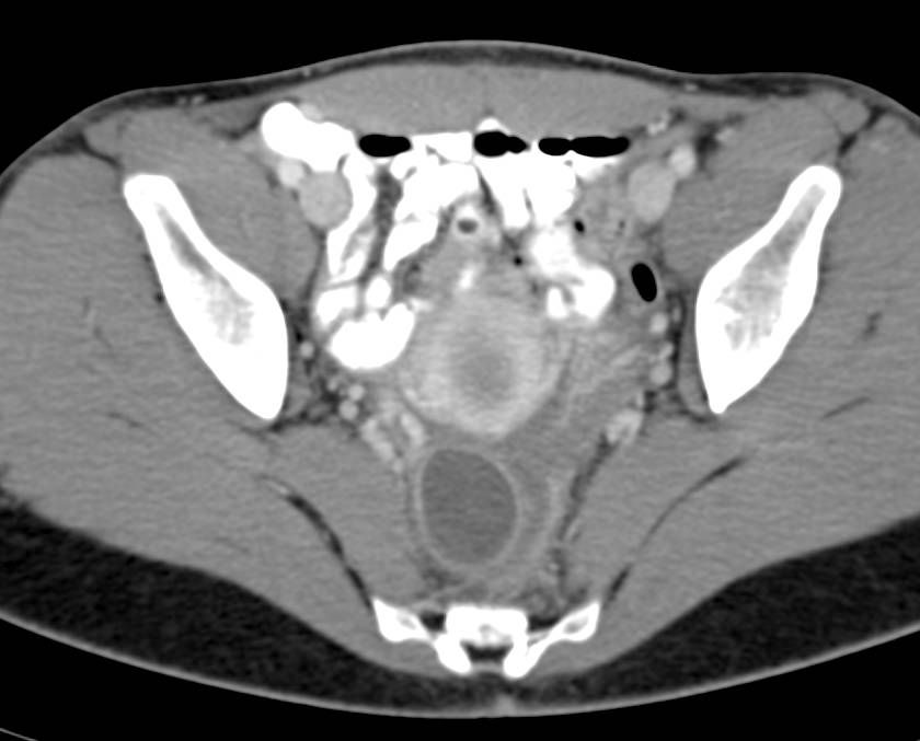 ectopic-pregnancy-ob-gyn-case-studies-ctisus-ct-scanning