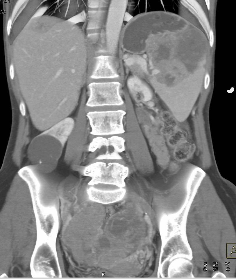 Ovarian Cystadenocarcinoma with Tumor Implants on Liver and Spleen - CTisus CT Scan