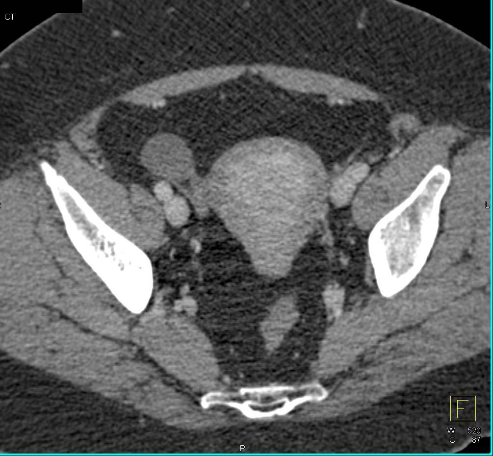 Endometriosis on Right Ovary - CTisus CT Scan