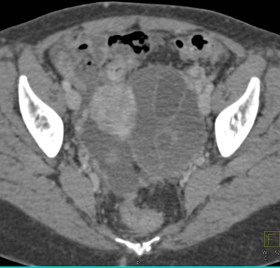 Ovarian Cystadenocarcinoma with Tumor Implants - CTisus CT Scan