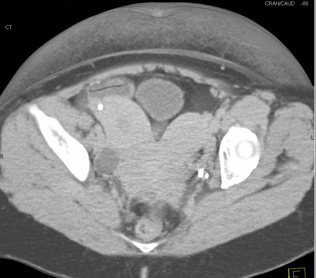 Bicornuate uterus - CTisus CT Scan