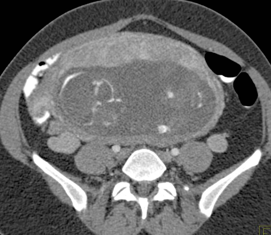 Normal Placenta and Baby in Trauma Patient - CTisus CT Scan