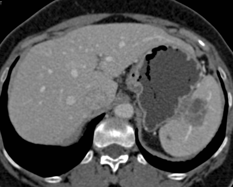 Ovarian Cancer with Splenic Implants - CTisus CT Scan