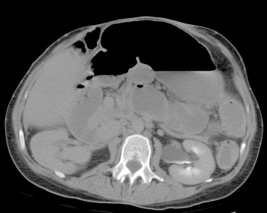 Pelvic Abscess with Right Sided Deep Vein Thrombosis (DVT) - CTisus CT Scan