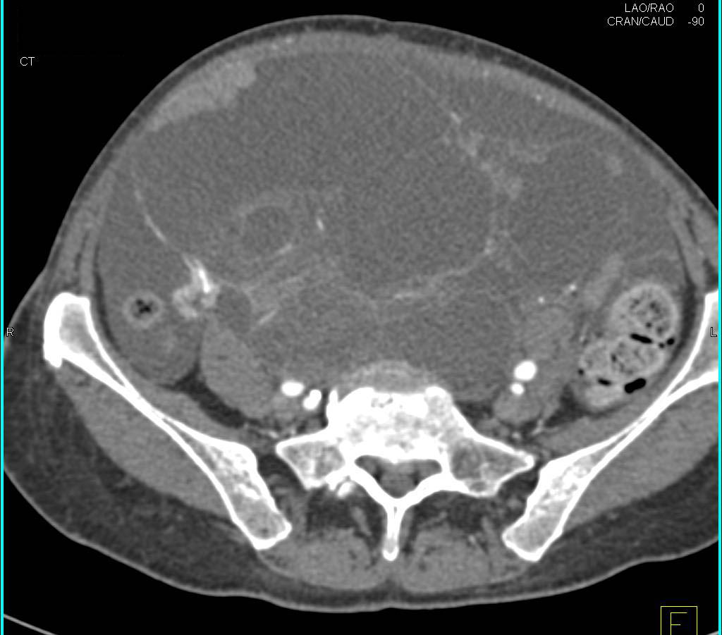 Ovarian Cystadenocarcinoma with Carcinomatosis - CTisus CT Scan