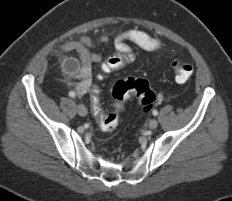 Pelvic Inflammatory Disease (PID) Simulates Acute Appendicitis - CTisus CT Scan