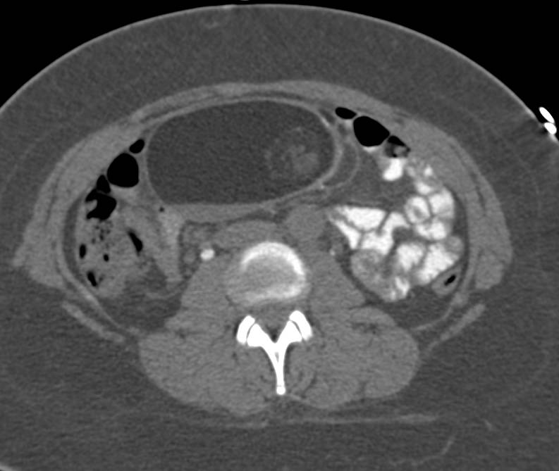 Classic Ovarian Dermoid High in Position - CTisus CT Scan