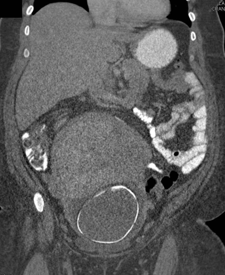 Intrauterine Pregnancy - CTisus CT Scan