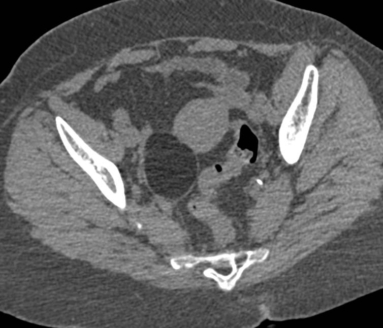 Ovarian Dermoid - CTisus CT Scan