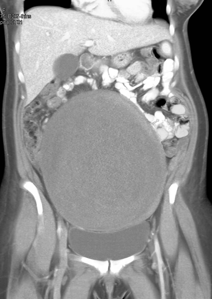 Ovarian Cystadenocarcinoma - CTisus CT Scan