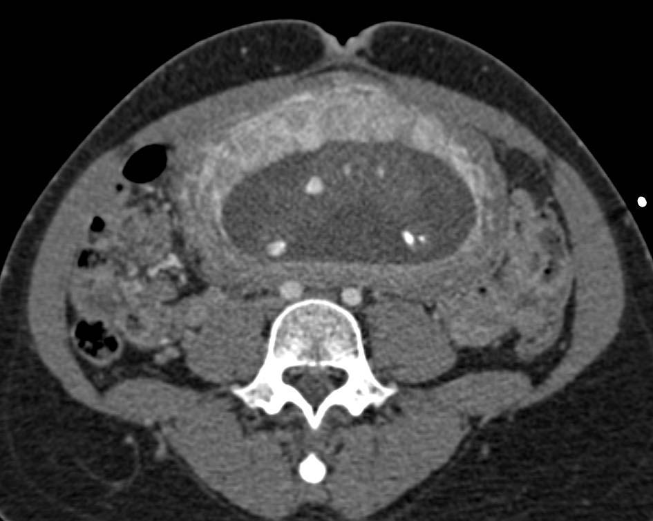 Normal Placenta and fetus s/p Trauma - CTisus CT Scan