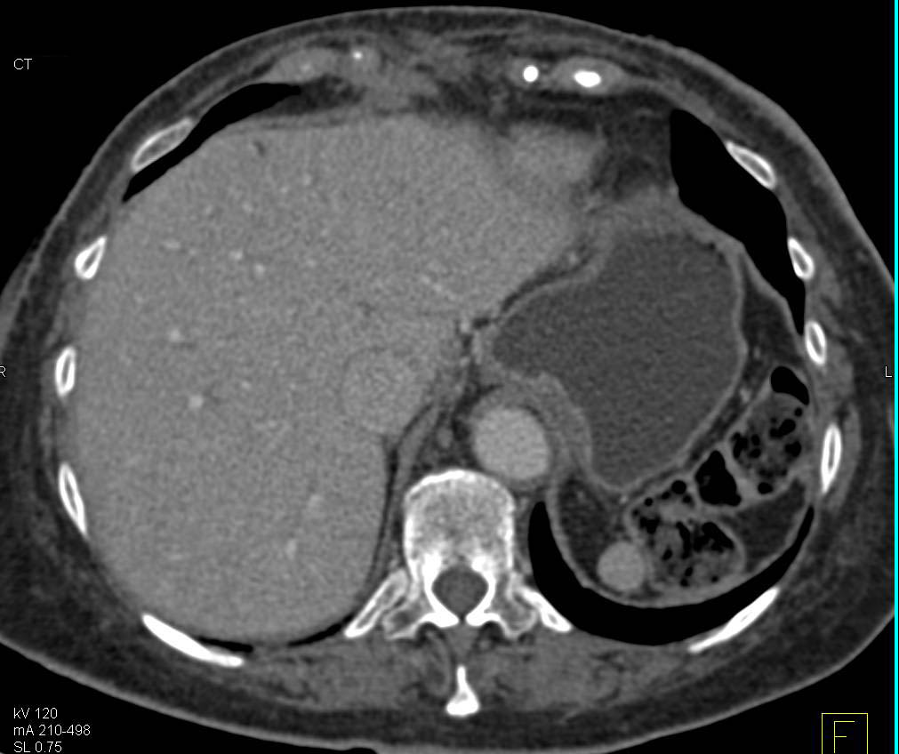 Pessary in the Pelvis - CTisus CT Scan