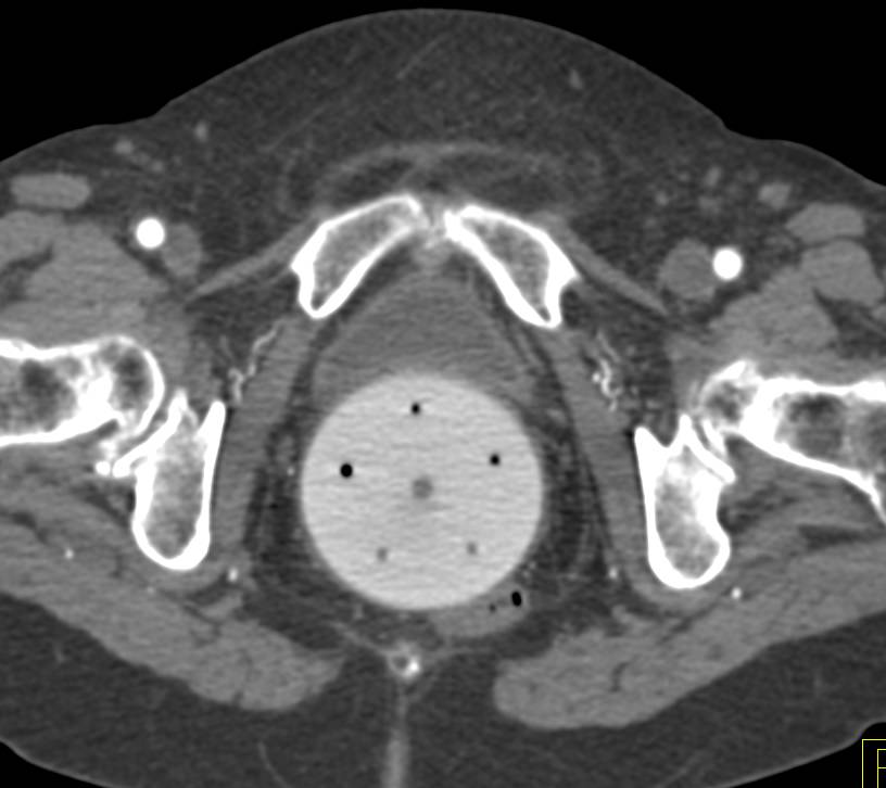 Pessary in Place - CTisus CT Scan