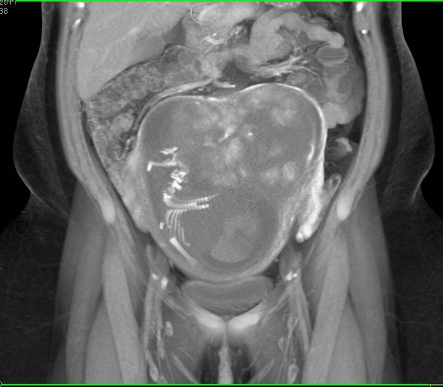 Pregnancy with Mermaid Fetus Pre-Termination of Pregnancy - CTisus CT Scan