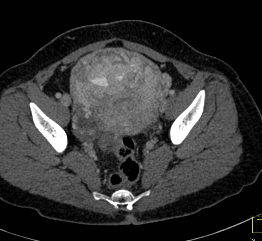 Uterine Mass with Impressive Vascular Collaterals - CTisus CT Scan