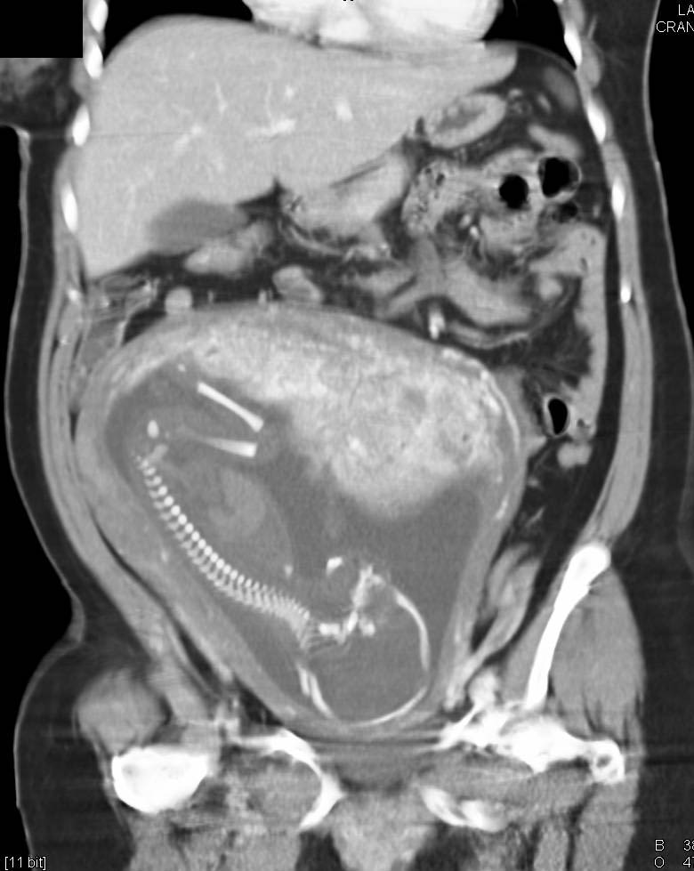 Intrauterine Pregnancy in a Trauma Patient - CTisus CT Scan