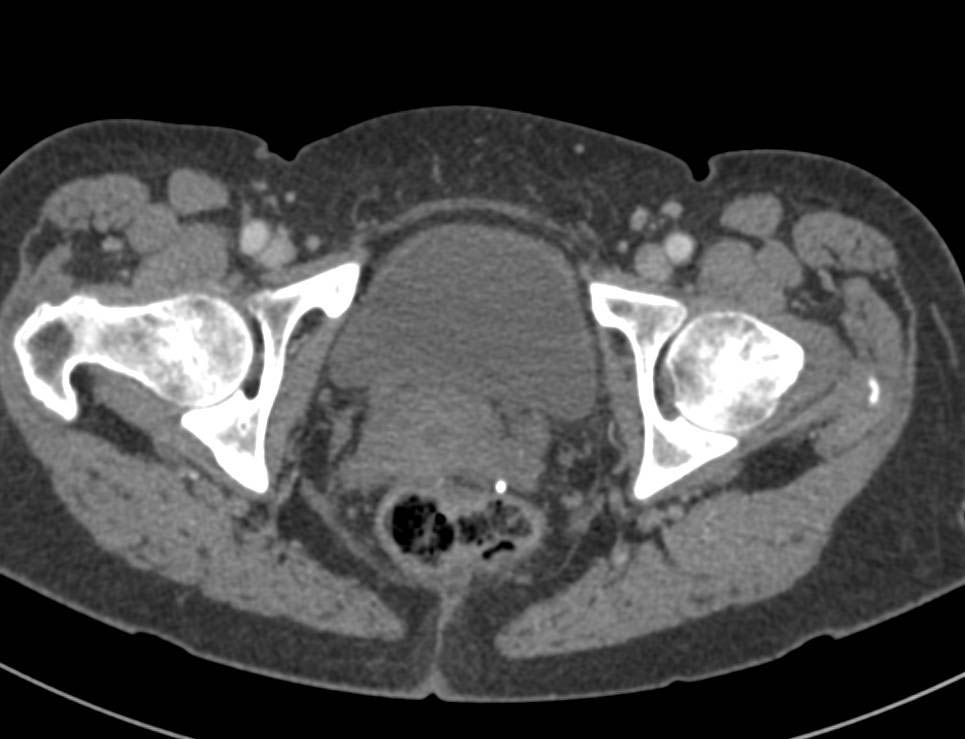 Ovarian Carcinomatosis - CTisus CT Scan