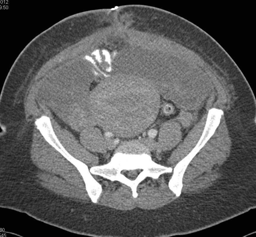 Ovarian Carcinoma with Bilateral Adnexal Masses - CTisus CT Scan