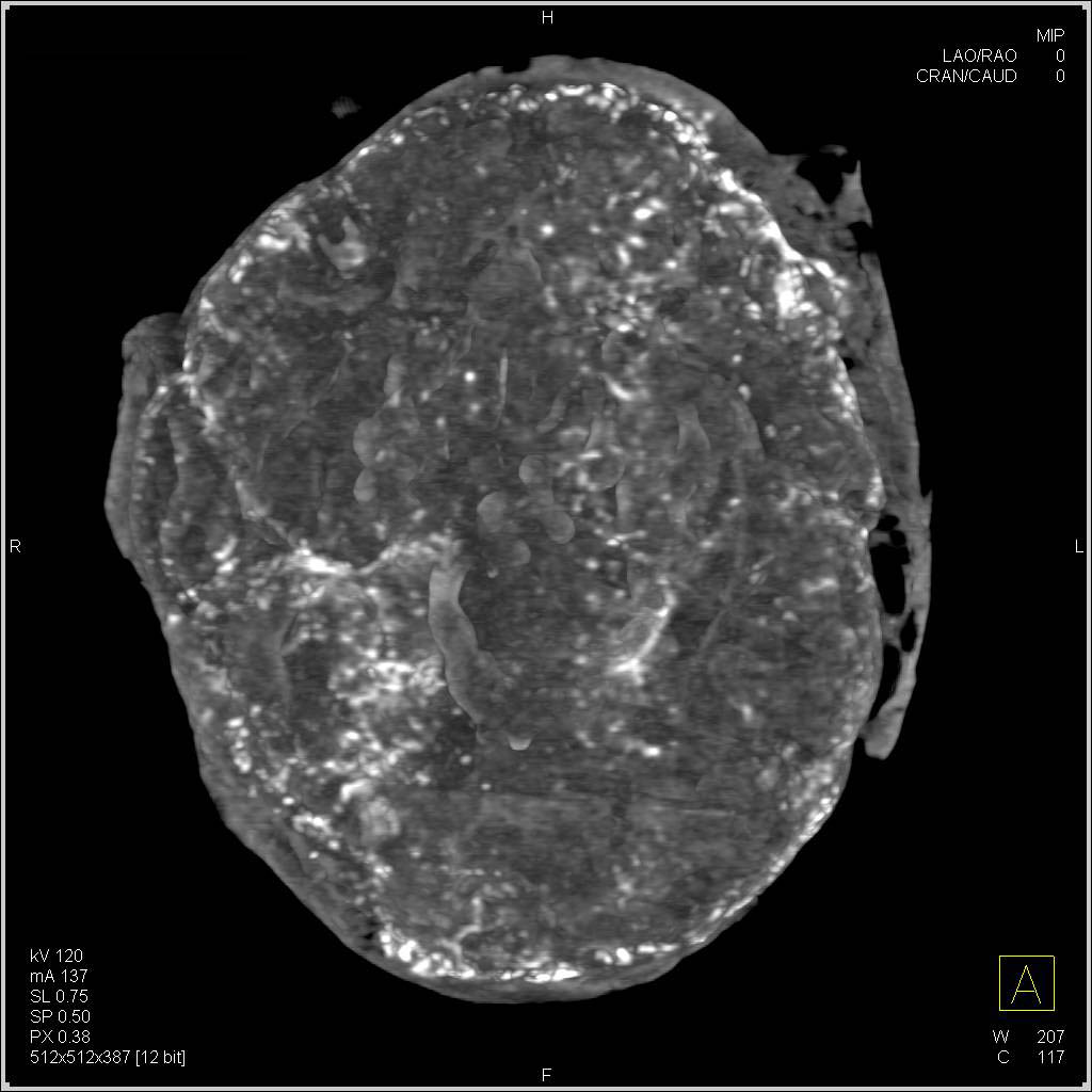 3D of Placenta with Dystrophic Calcifications - CTisus CT Scan