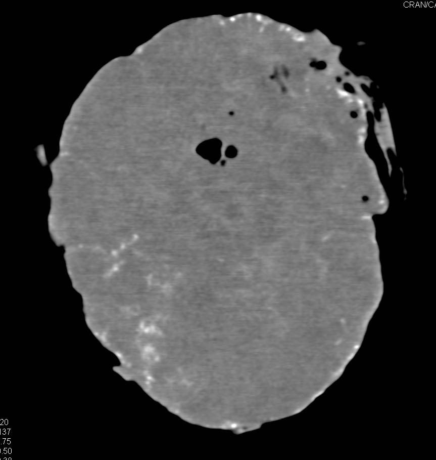 Premature Calcification Seen in a Placenta - CTisus CT Scan