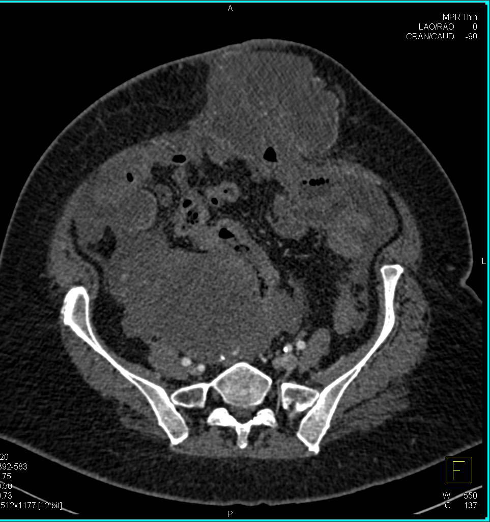 Ovarian Cancer with Carcinomatosis - CTisus CT Scan