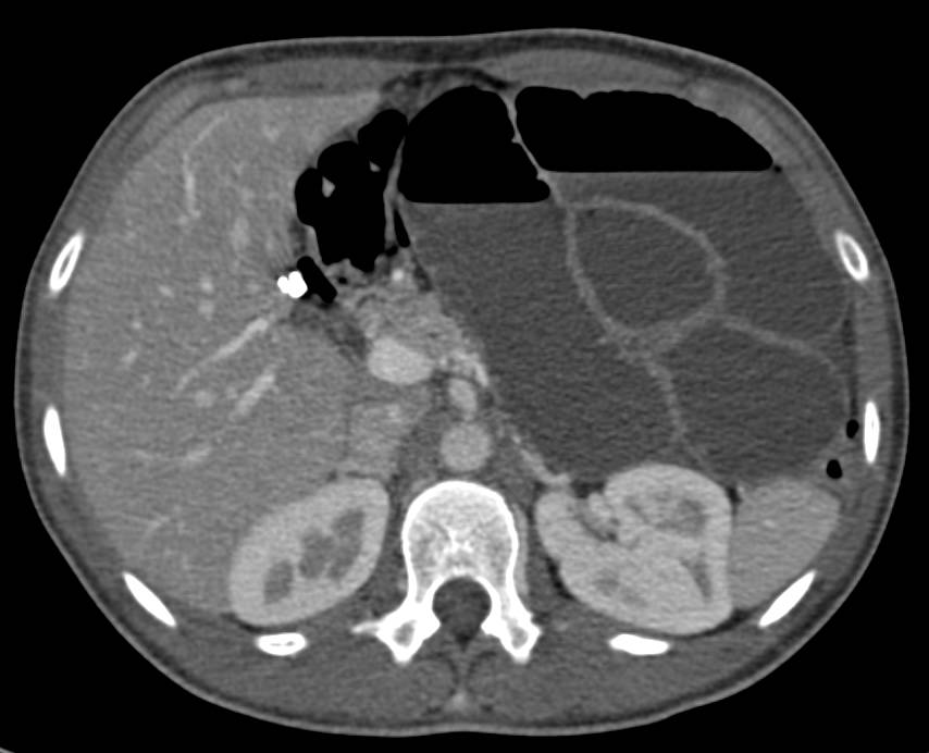 CT for Evaluation of Small Bowel Obstruction (SBO) with Unsuspected Pregnancy - CTisus CT Scan
