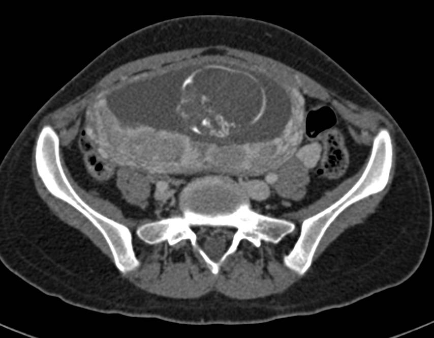 Pregnant Patient was in MVA - CTisus CT Scan
