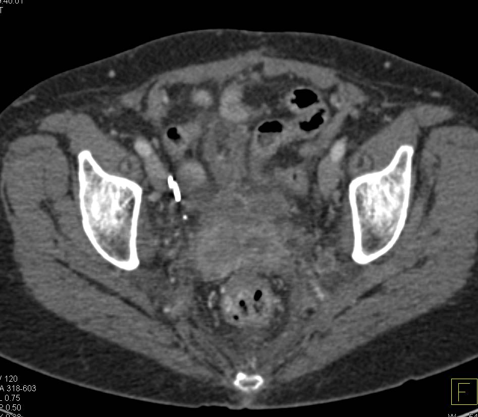 Cervical Cancer with Adenopathy - CTisus CT Scan