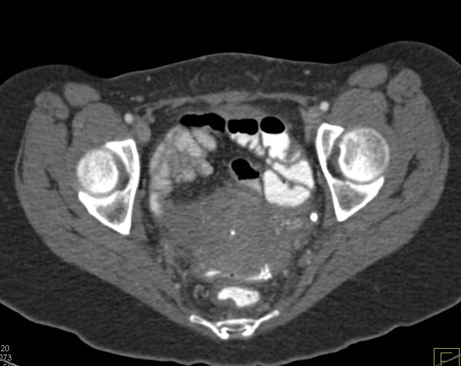 Rectovaginal Fistulae - CTisus CT Scan