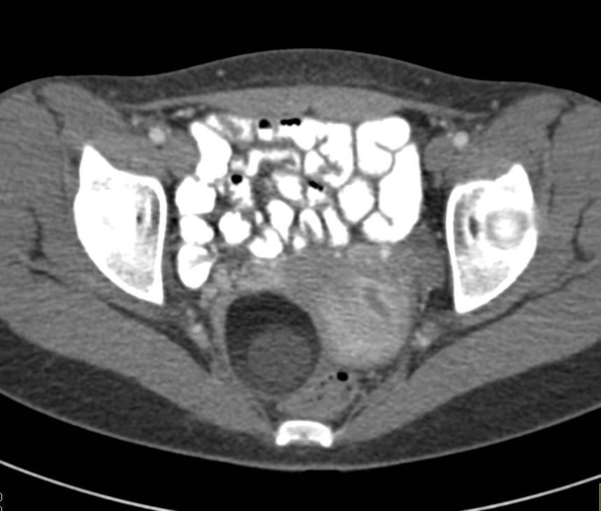 Ovarian Dermoid Tumor - CTisus CT Scan