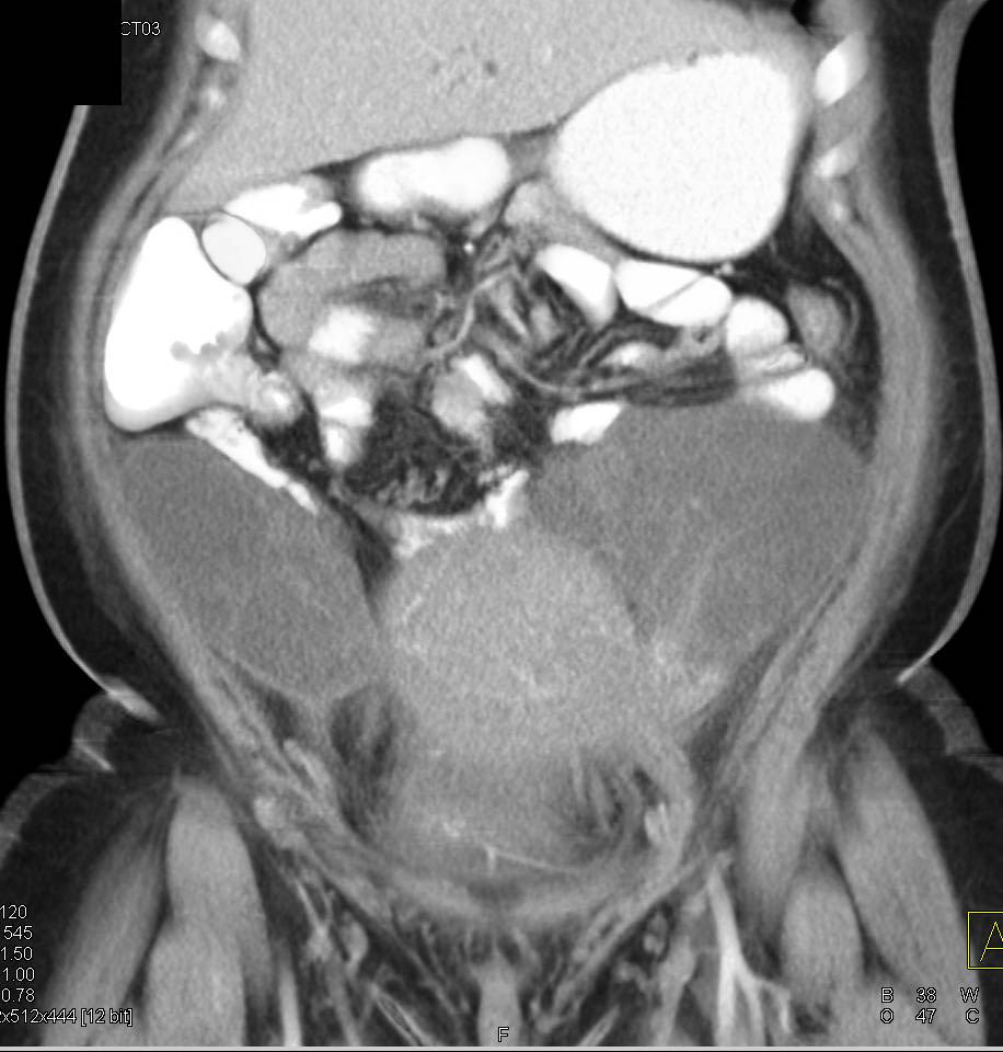 Bilateral Enlargement of the Ovaries - CTisus CT Scan