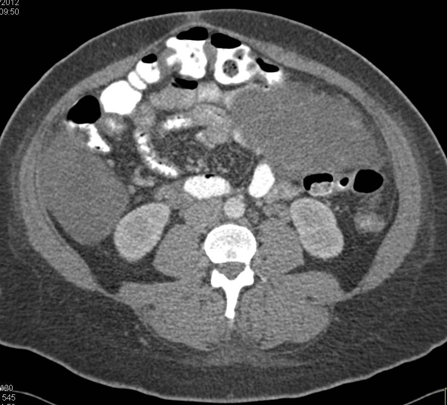 Bilateral Enlarged Ovarian Masses - CTisus CT Scan