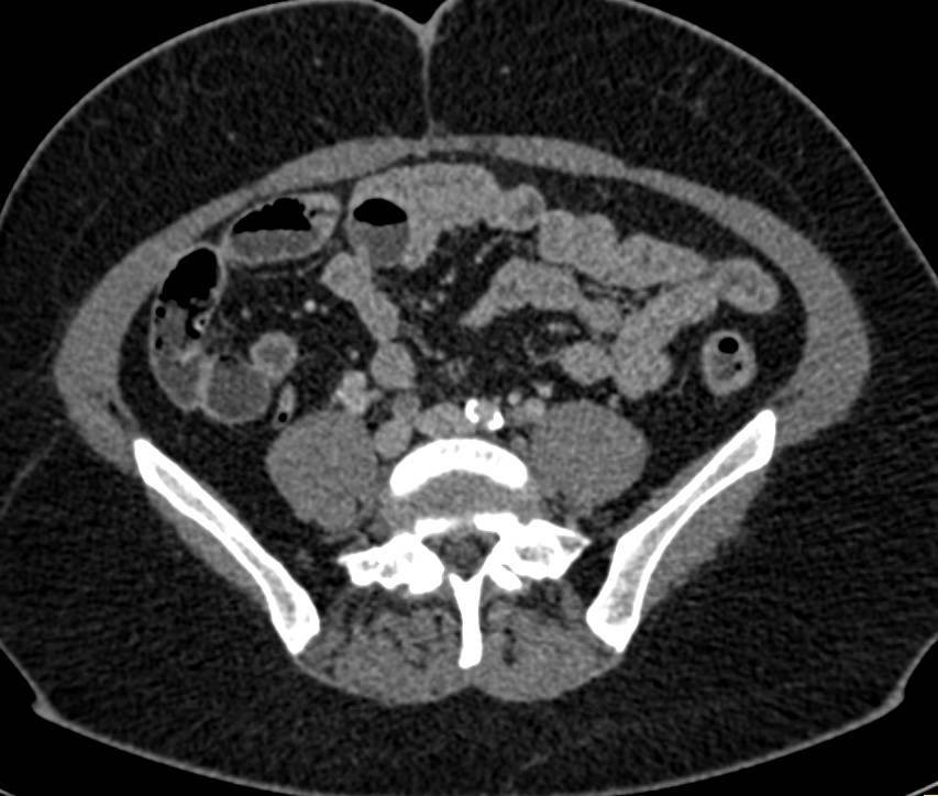 Enhancing Uterine Fibroids - CTisus CT Scan