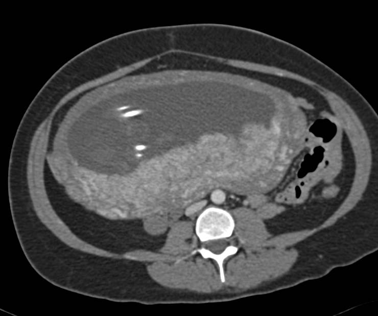 Normal Placenta, Baby and Mom s/p Trauma - CTisus CT Scan