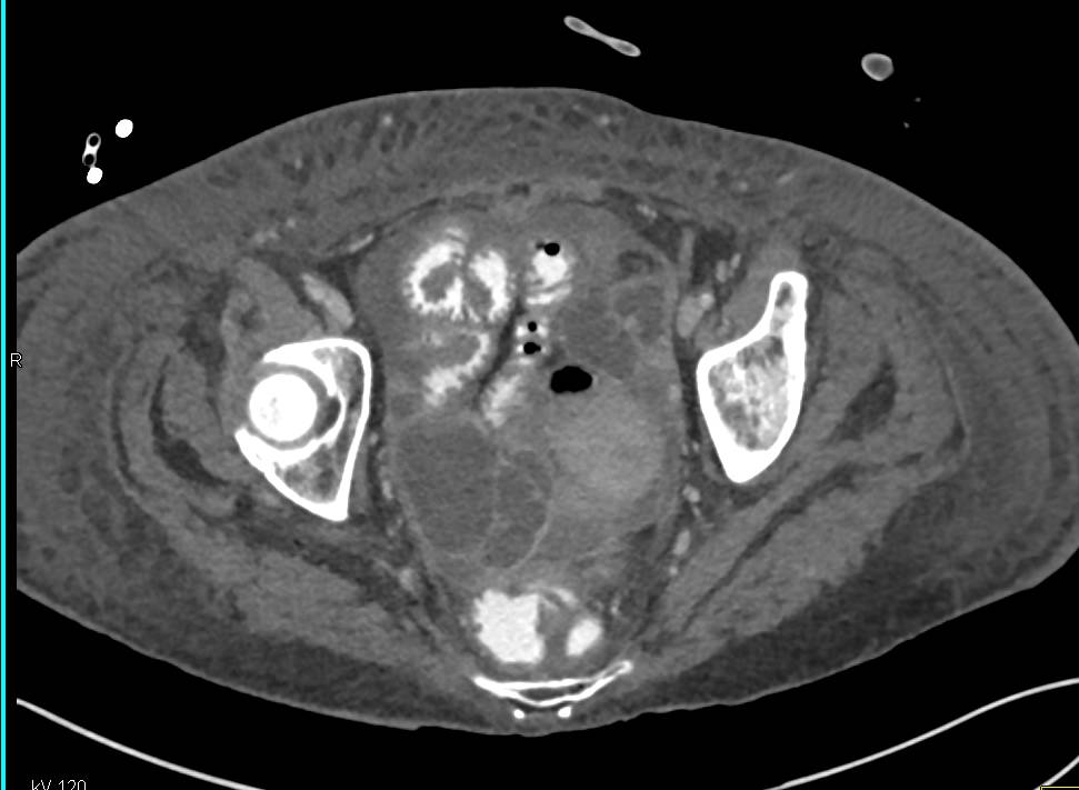 Tubo-Ovarian Abscess - CTisus CT Scan