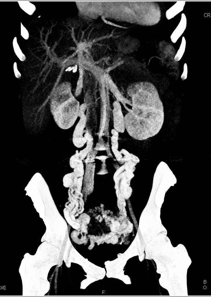 Pelvic Congestion Syndrome in 3D VRT - CTisus CT Scan